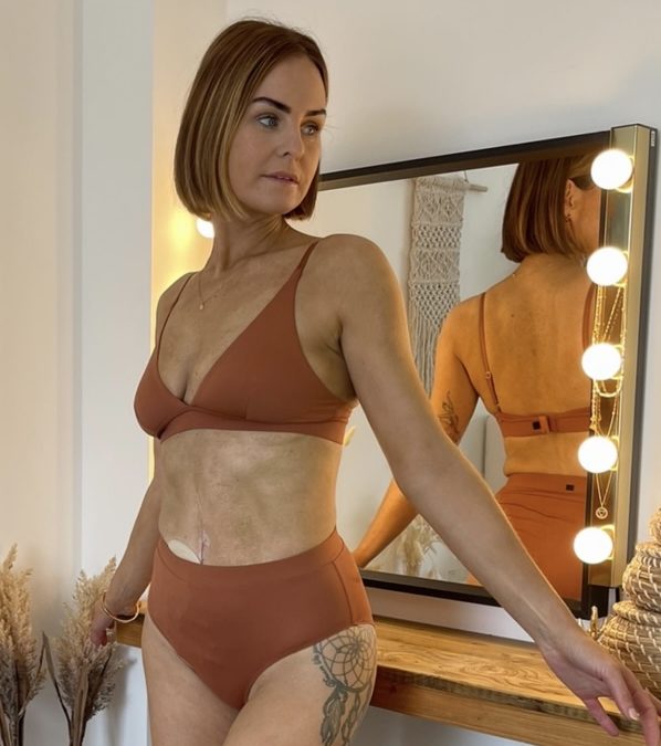 Body confidence with a stoma | by Maryrose