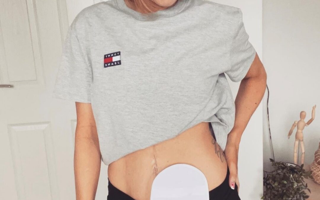 Telling others about your stoma | by Maryrose