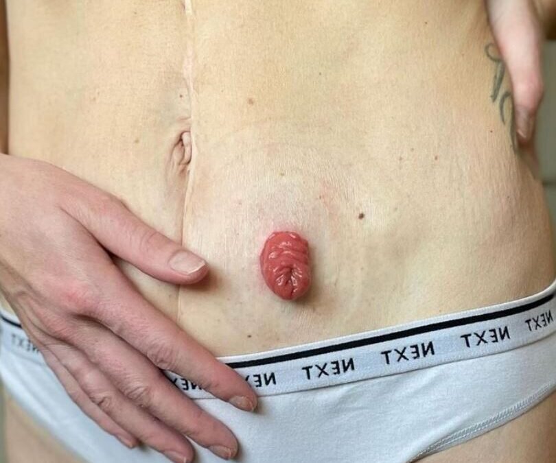 Navigating stoma blockages