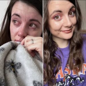 Amy showing the raw and vulnerable side to having a stoma on the left, while she shows her happy, confident self on the right.