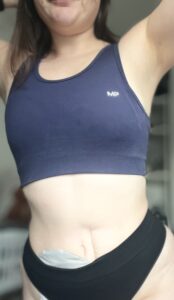 Amy poses in front of the camera without her face, wearing underwear and her stoma bag on show.